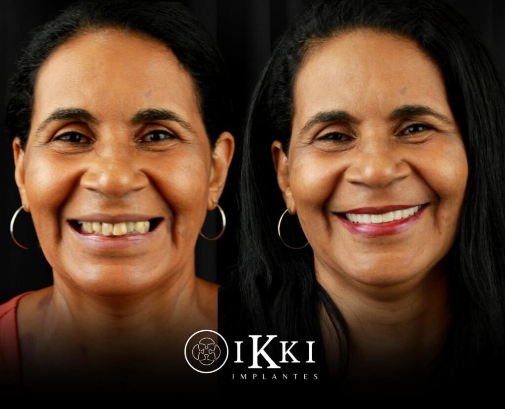 04 - ANTES E DEPOIS - 27.05