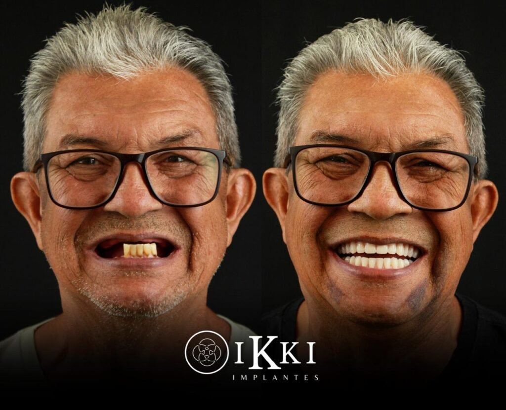 14 - ANTES E DEPOIS - 03.09