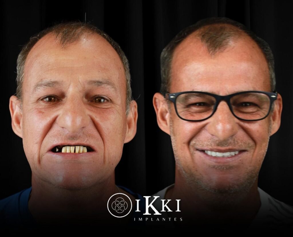 15 - ANTES E DEPOIS - 03.09