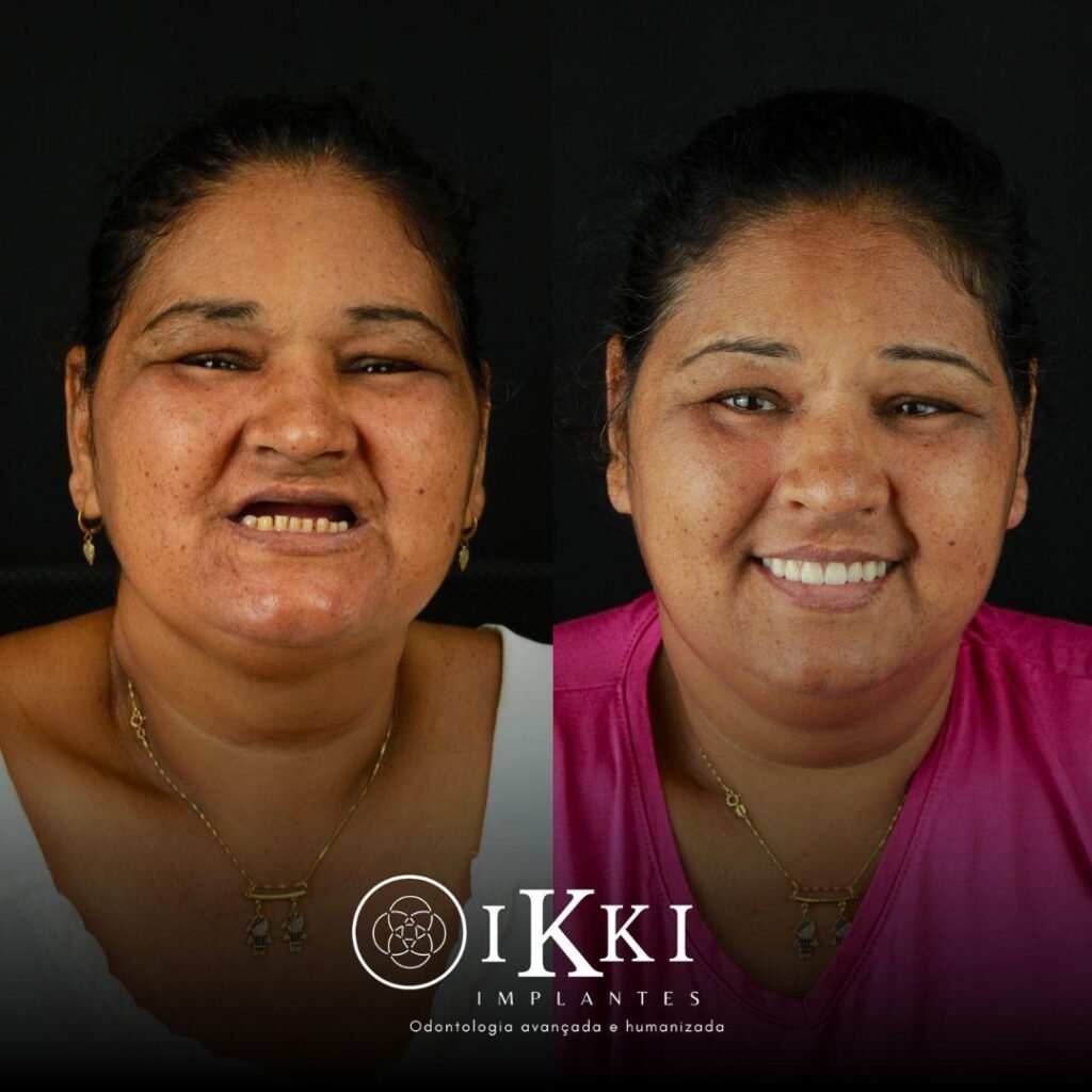 23 - ANTES E DEPOIS - 03.09